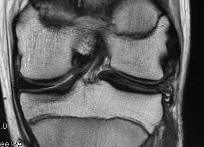 Discoid Meniscus with intrasubstance degeneration